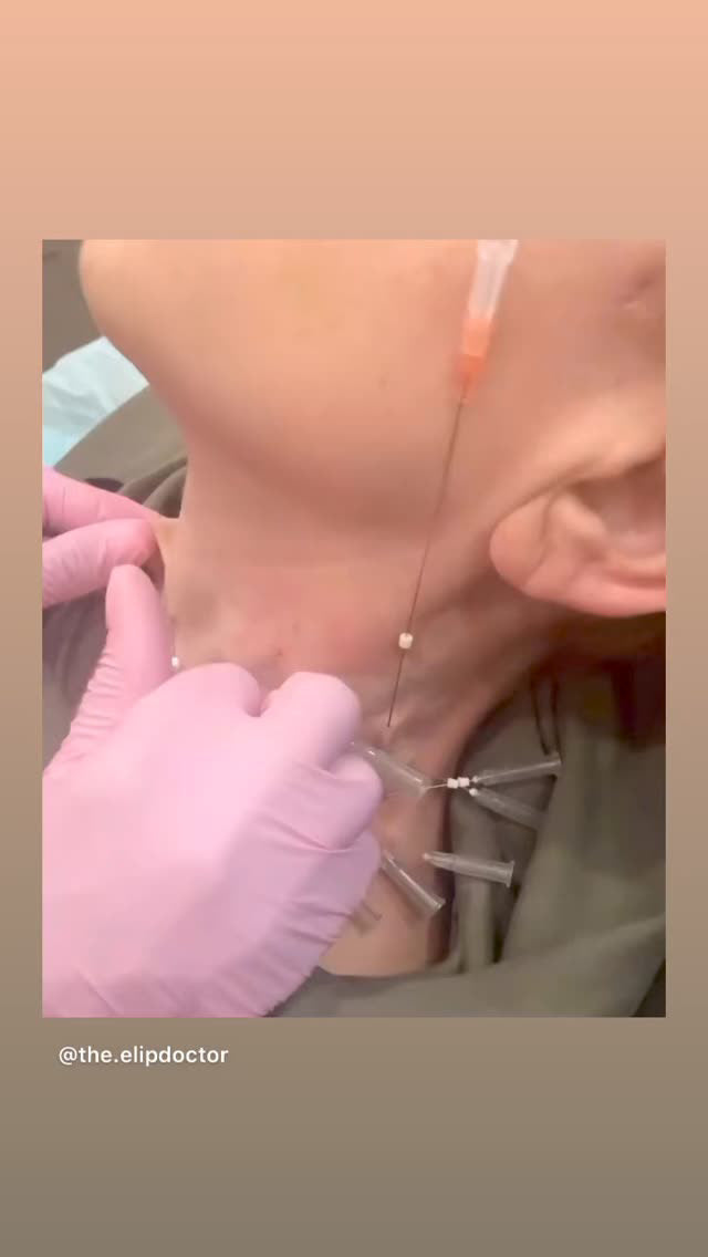 Theelipdoctor PDO Smoothing Thread course L1